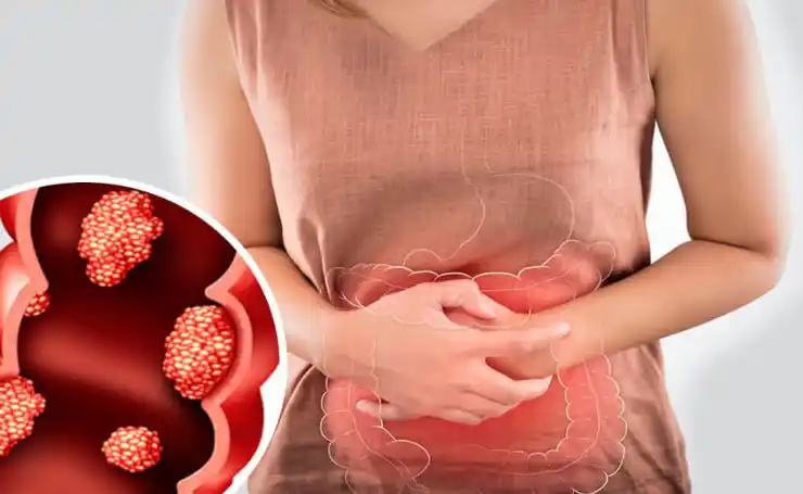 Ilustrasi Kanker Usus Besar (Foto: Ist)